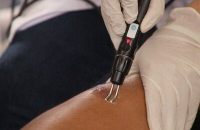 Leishmaniasis