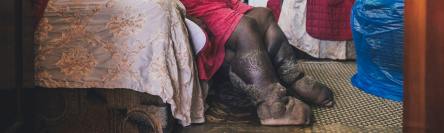 Lymphatic filariasis feature image